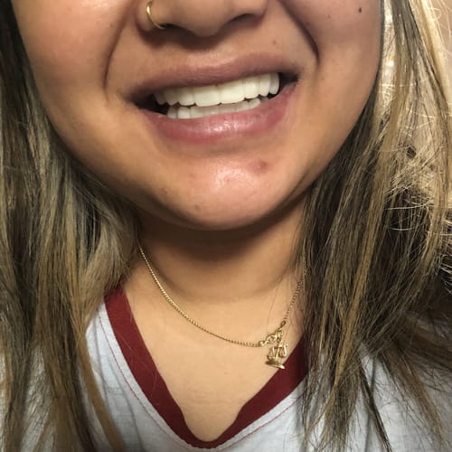 Customer photo review of Teeth-Veneer 2.0