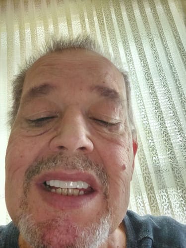 Customer photo review of Teeth-Veneer 2.0