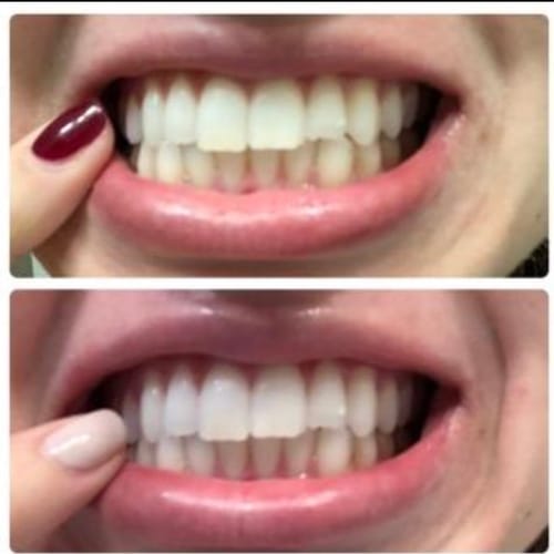 Customer photo review of Polar MD Teeth Whitening Kit