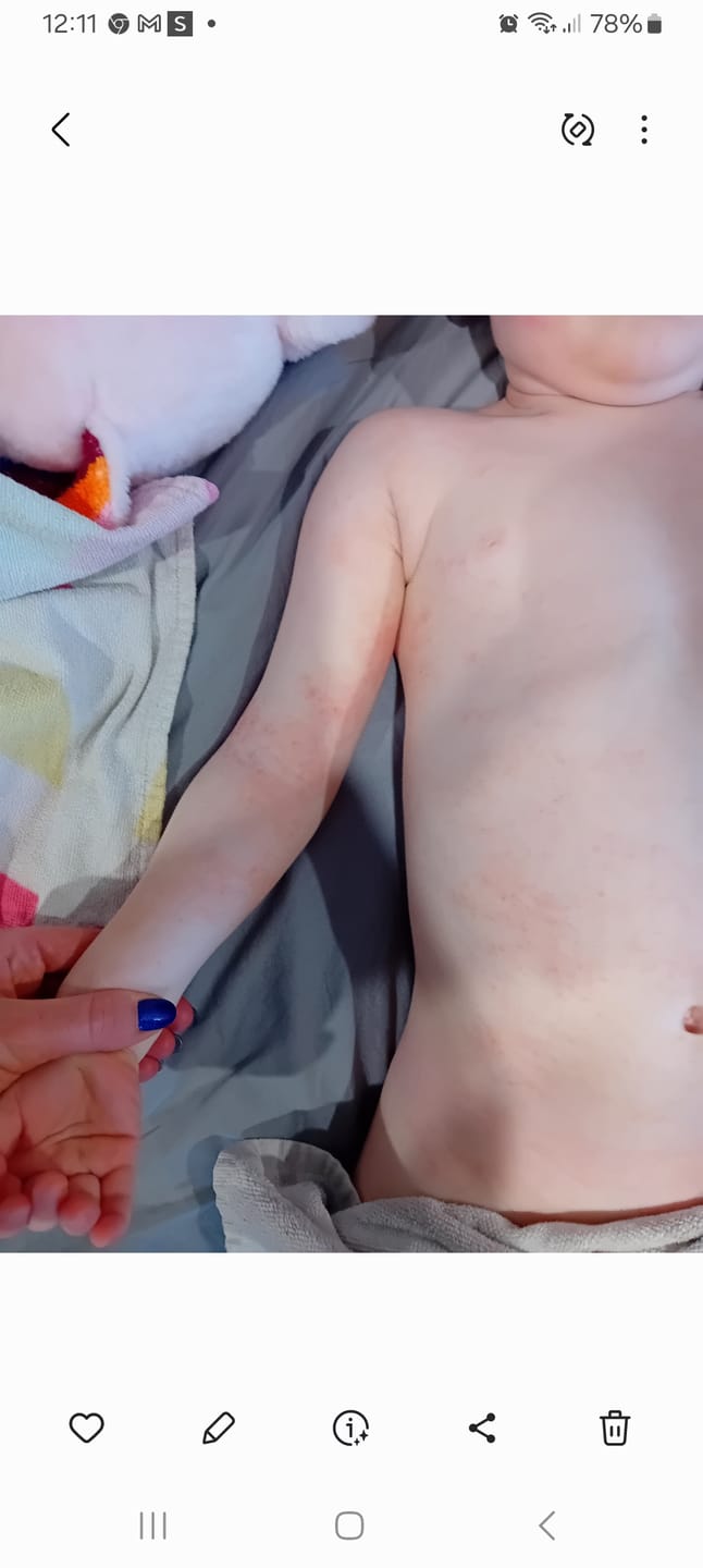 Customer photo review of Bioskin Junior Outbreak Rescue Cream
