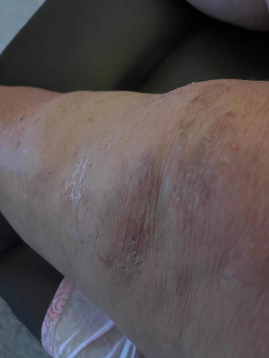 Customer photo review of Auxillium Knee Patch (fka Heaven Patch)