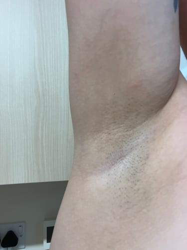 Customer photo review of Pink Blossom - Intimate Area Brightening Treatment