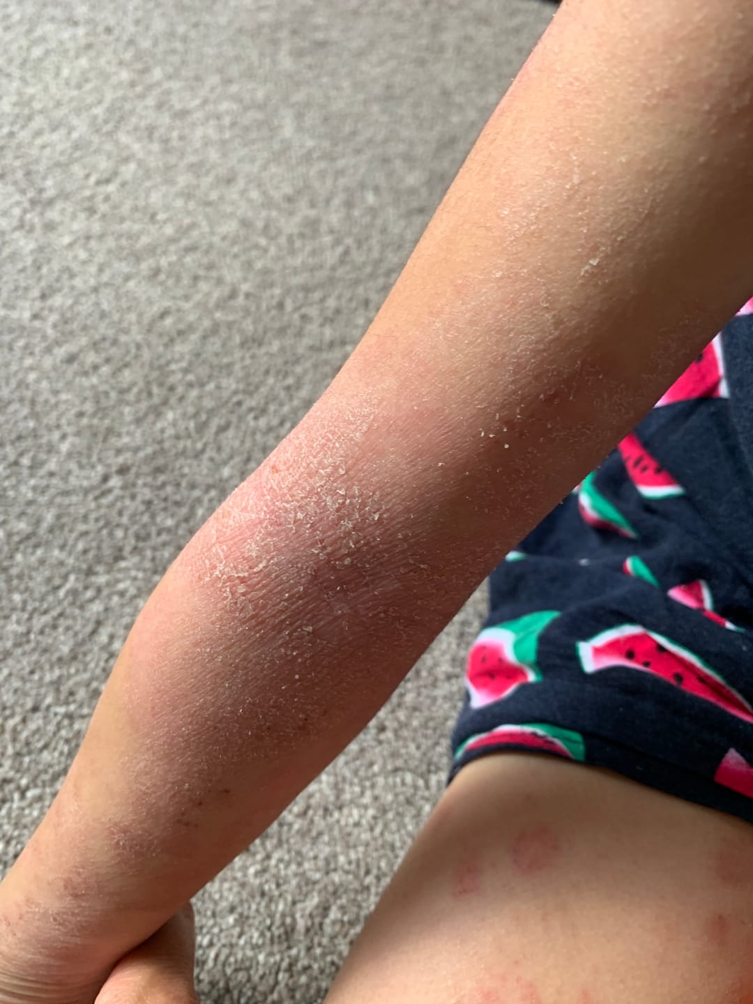 Customer photo review of Bioskin Junior Duo Pack (Free Outbreak Rescue Cream)