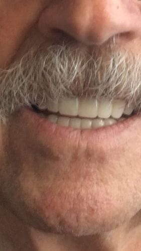 Customer photo review of Teeth-Veneer 2.0