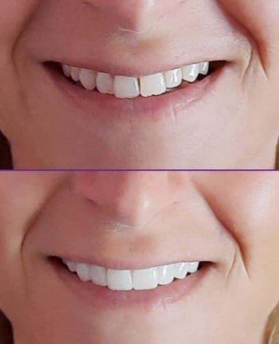 Customer photo review of Teeth-Veneer 2.0