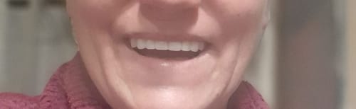 Customer photo review of Teeth-Veneer 2.0