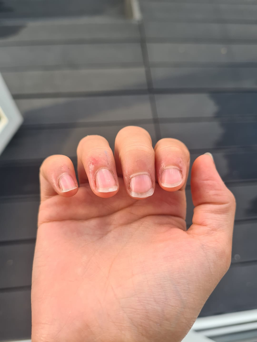 Customer photo review of Crystal Clear DIY Semicured Gel Nail Sticker Kit (STOP NAIL BITING & GROW BRITTLE NAILS)
