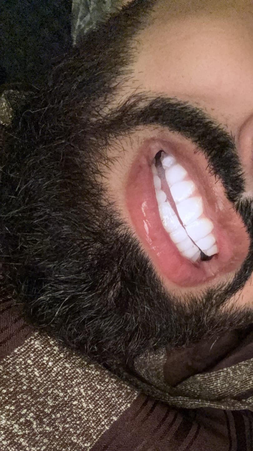Customer photo review of Teeth Whitening Strips