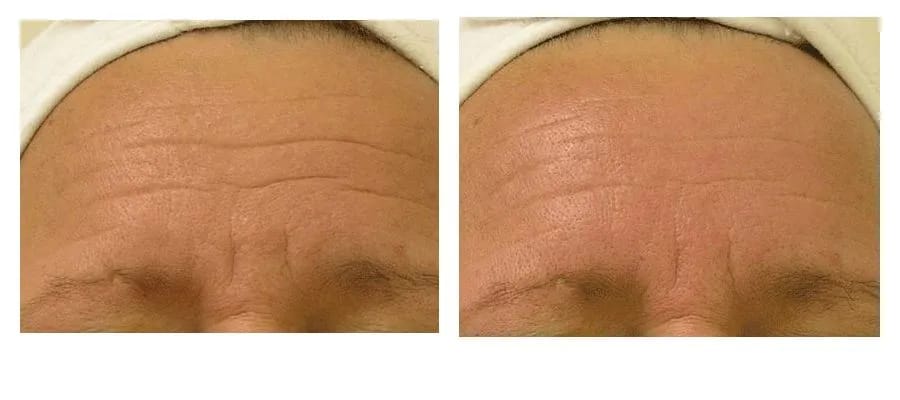 Customer photo review of Bliss™- Collageen Proteine