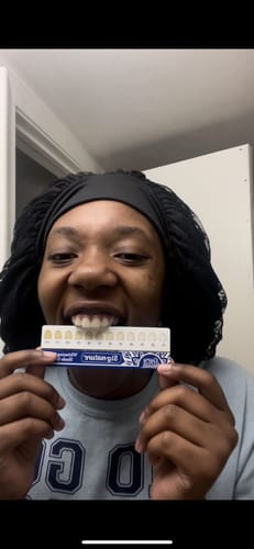 Customer photo review of Whitening Strips (7-day treatment)