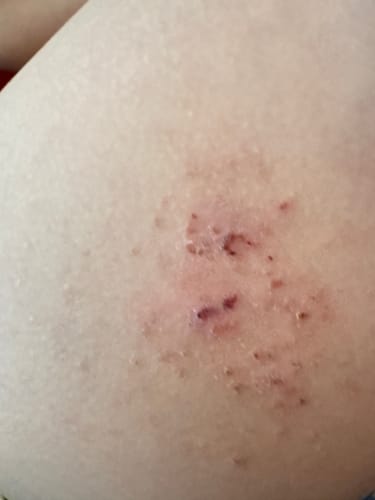Customer photo review of B-Restore™ Barrier Cream