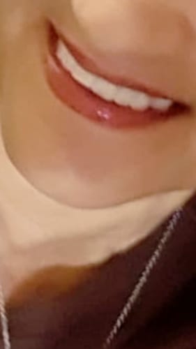 Customer photo review of Teeth-Veneer 2.0