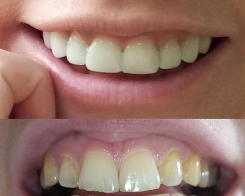 Customer photo review of Teeth-Veneer 2.0
