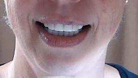 Customer photo review of Teeth-Veneer 2.0