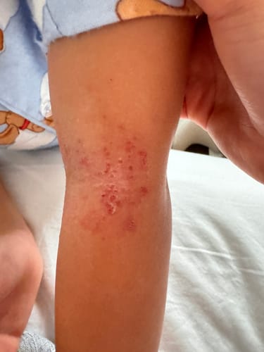 Customer photo review of B-Restore™ Barrier Cream