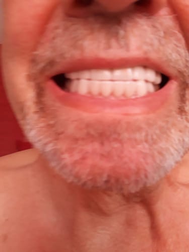 Customer photo review of Teeth-Veneer 2.0