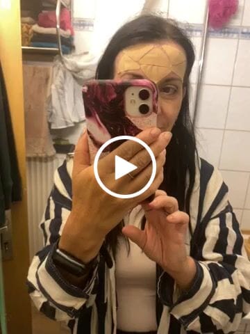 Customer video review of Zornesfalten Patches mit Hyaluron