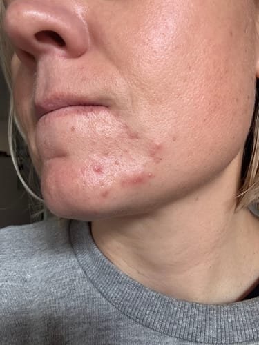 Customer photo review of Intermediate Acne Program™