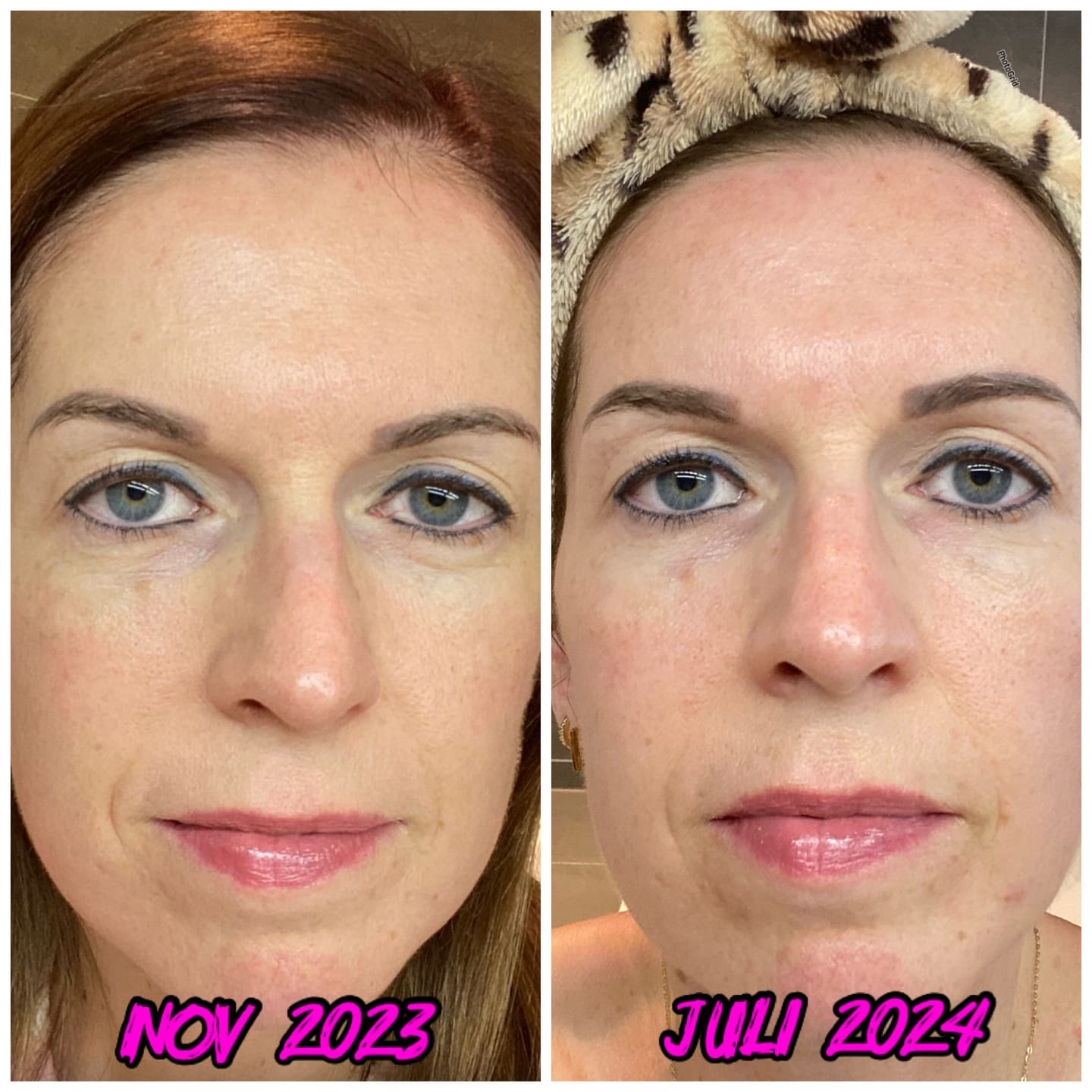 Customer photo review of Bliss™- Collageen Proteine