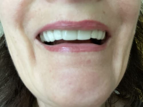 Customer photo review of Teeth-Veneer 2.0