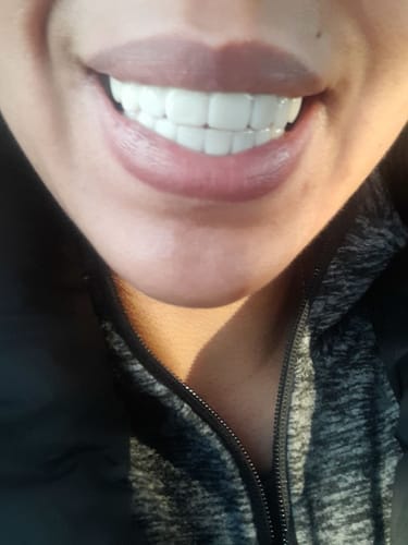 Customer photo review of Teeth-Veneer 2.0