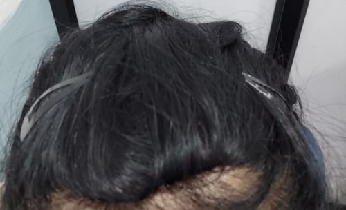 Customer photo review of INVISIBLE COVER-UP PATCH