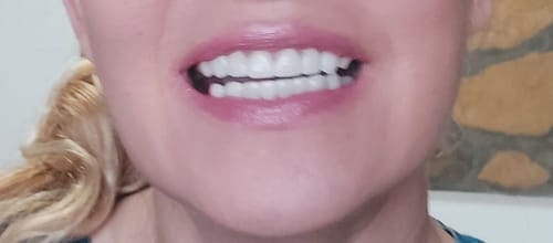 Customer photo review of Teeth-Veneer 2.0