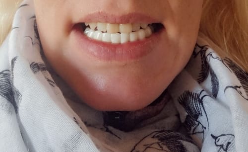 Customer photo review of Teeth-Veneer 2.0