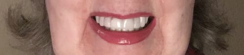 Customer photo review of Teeth-Veneer 2.0
