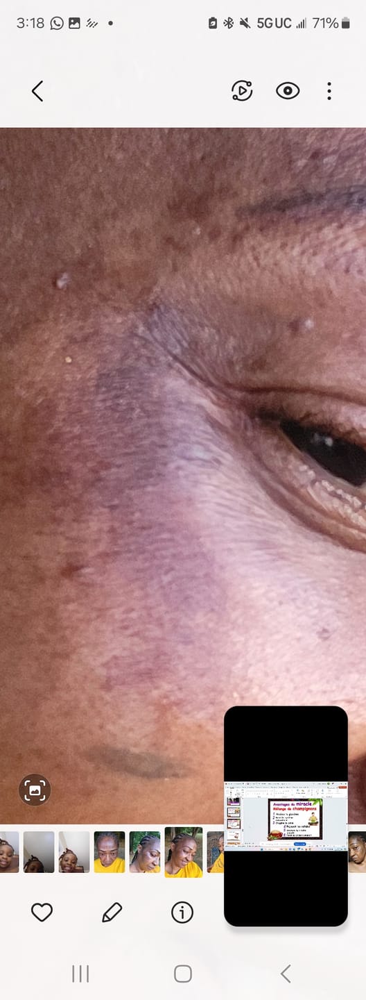 Customer photo review of Intense Discoloration Treatment (Rapid Action)