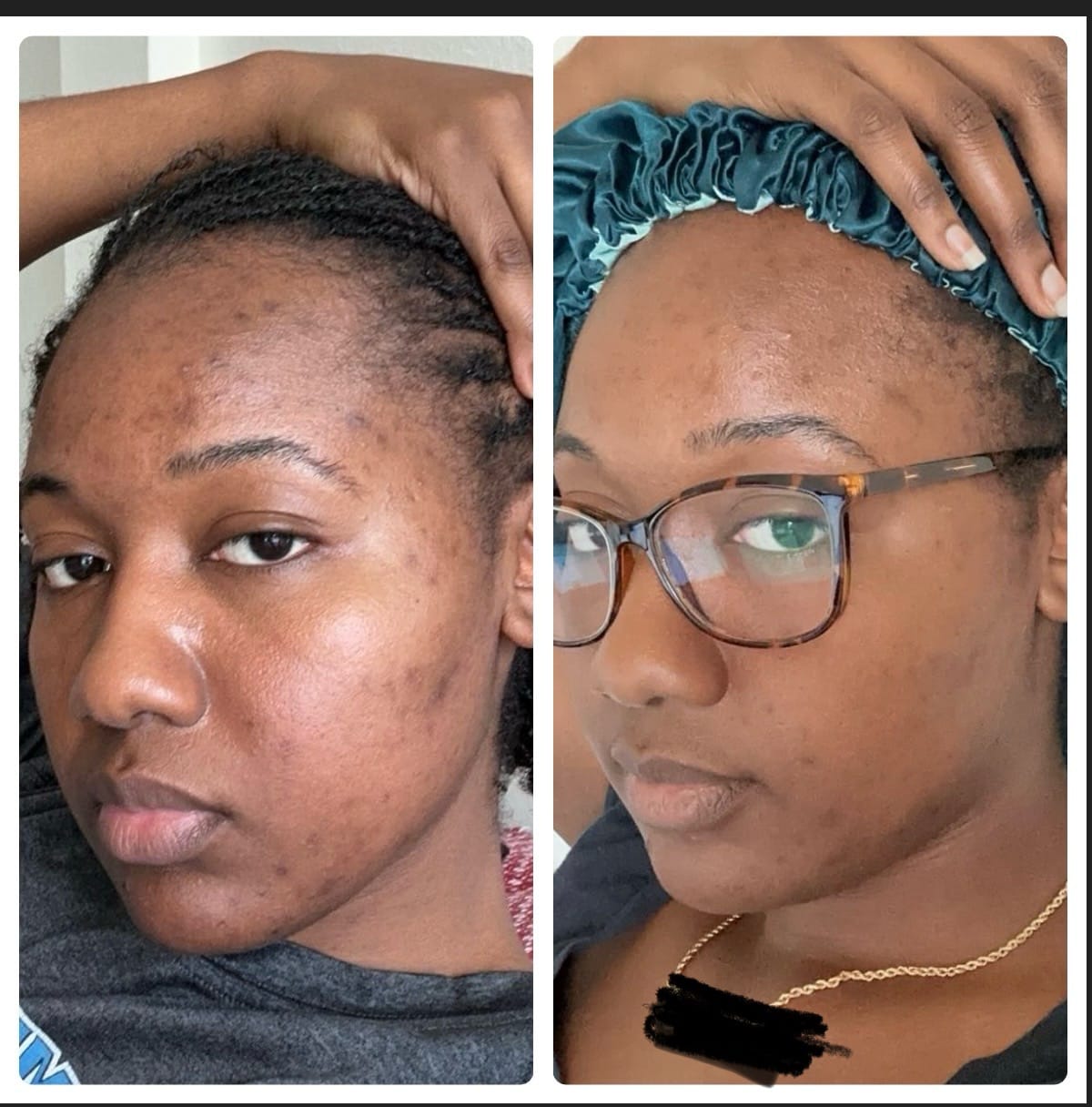 Customer photo review of Bolden Dark Spot Fix
