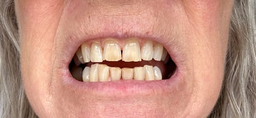 Customer photo review of Teeth Whitening Strips