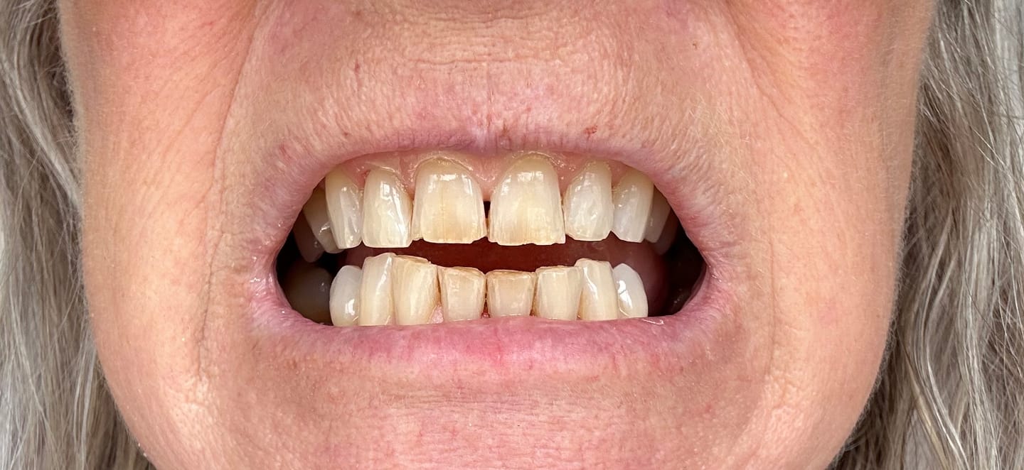 Customer photo review of Teeth Whitening Strips