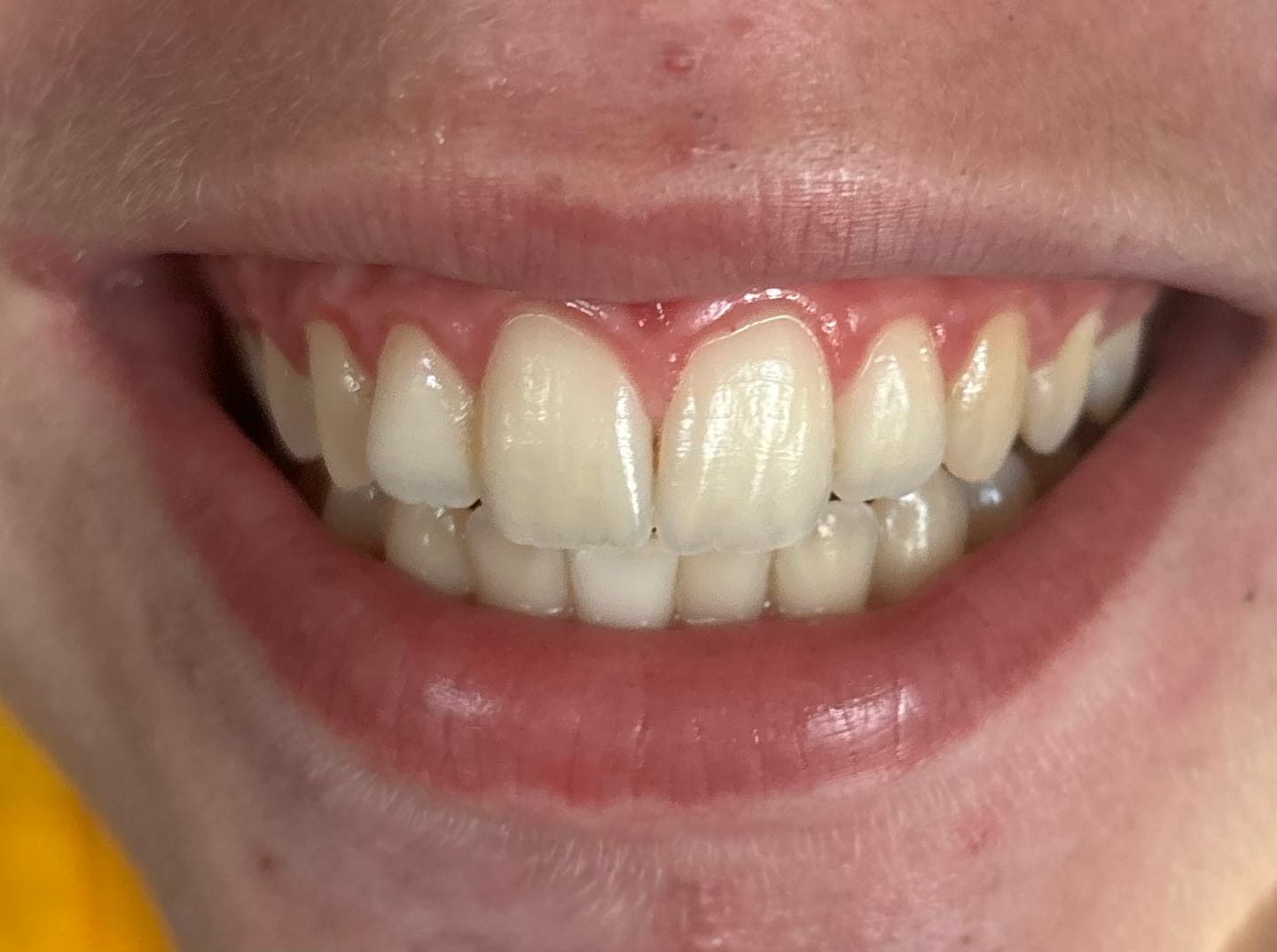 Customer photo review of Pack Bandes Violettes : 2 Paquets de Bandes Violettes Kauka Smile (sans peroxyde)