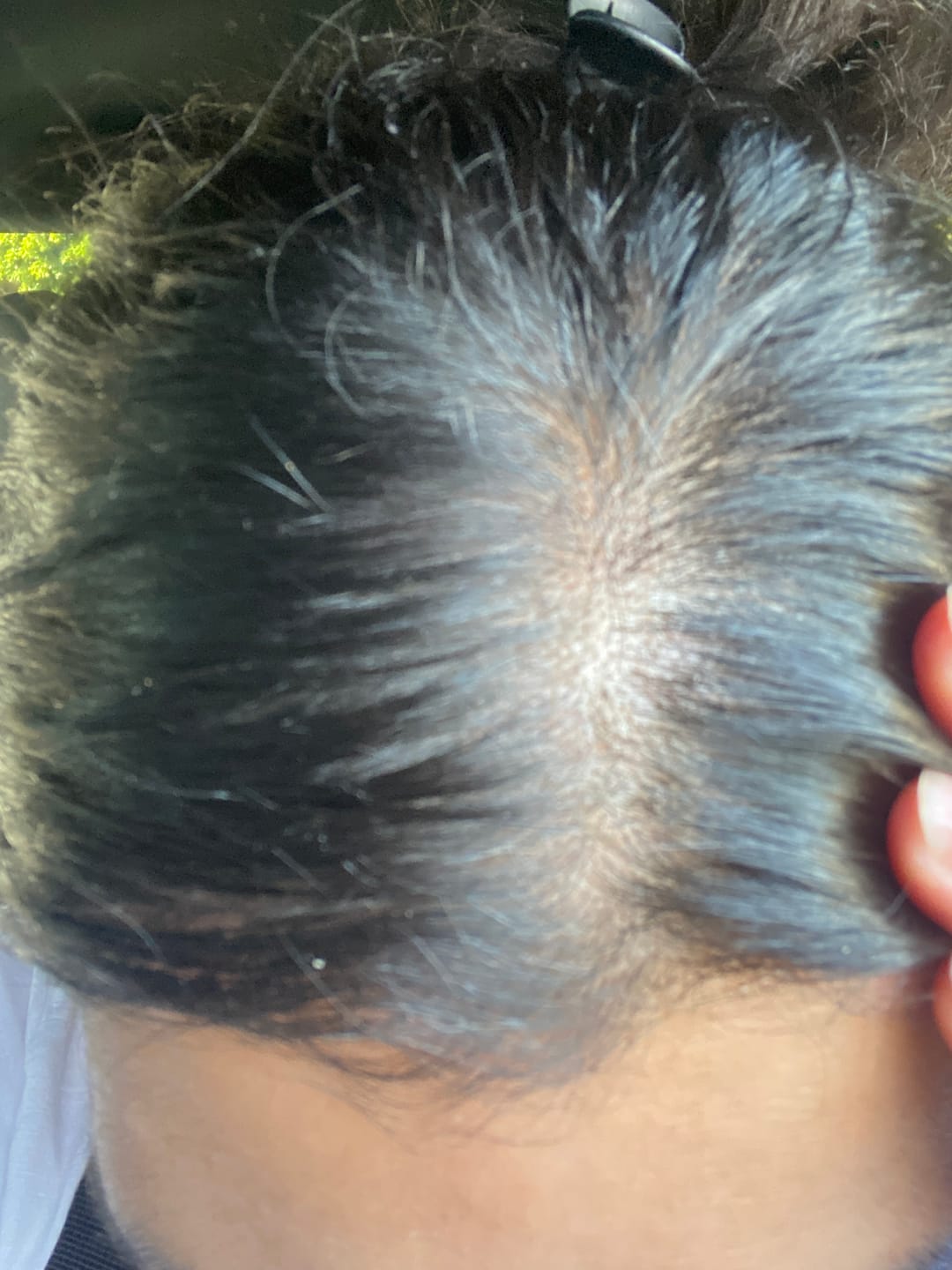Customer photo review of Psoriasis Honey Scalp Nourishing Kit