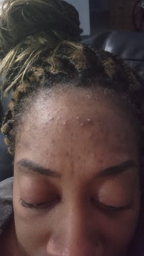 Customer photo review of Hypochlorous Acid Wipes for Skin & Face - 75 Ct