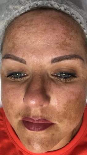 Customer photo review of Élimine les taches brunes du visage, le chloasma, les taches de vieillesse et les taches de rousseur