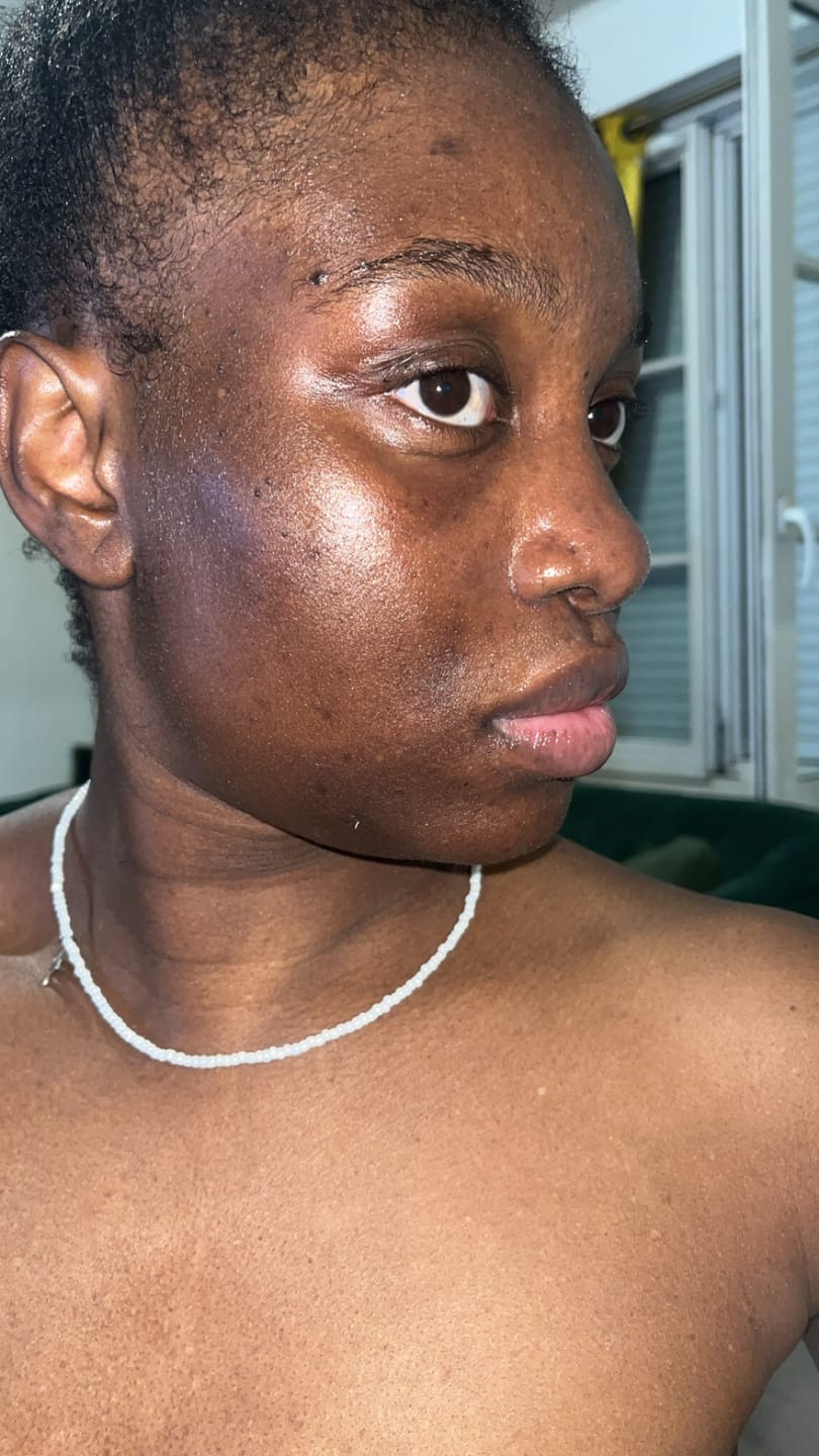 Customer photo review of Neoprosone Vitamin-C Brightening Serum - Fast Absorbing Serum - 30g / 1 Fl Oz