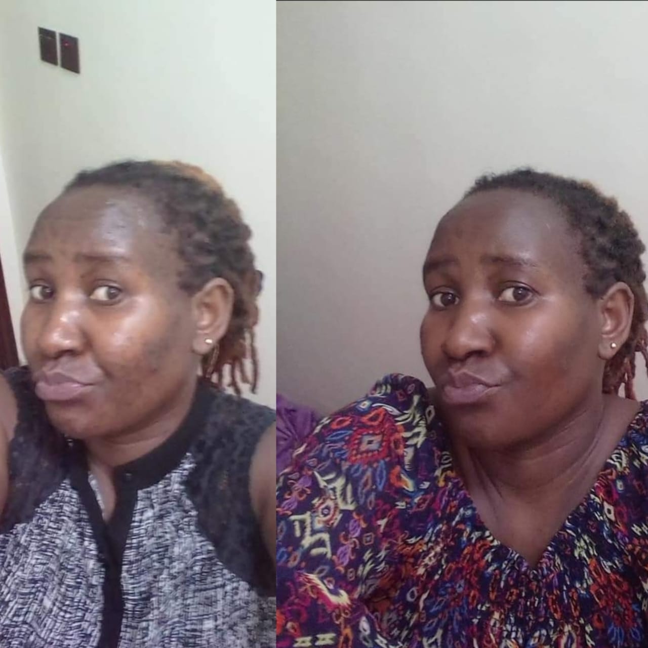 Customer photo review of Dark spots + Glow combo(offer ends today)