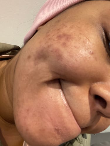 Customer photo review of Anti-Acne & Dark Spots African Soap