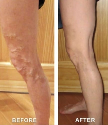 Customer photo review of 🔥LOVILDS™Varicose Veins Treatment Cream(Limited Time Discount Last Day)