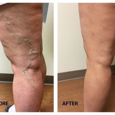 Customer photo review of 🔥LOVILDS™Varicose Veins Treatment Cream(Limited Time Discount Last Day)
