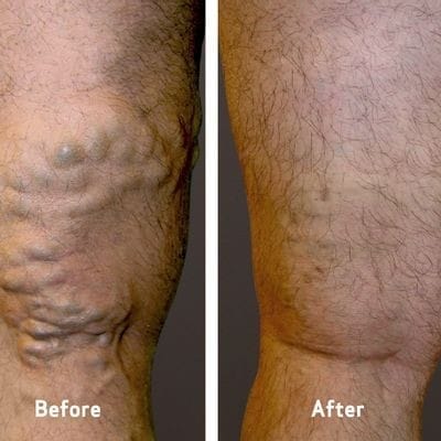Customer photo review of 🔥LOVILDS™Varicose Veins Treatment Cream(Limited Time Discount Last Day)