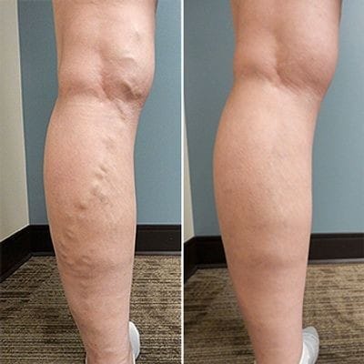 Customer photo review of 🔥LOVILDS™Varicose Veins Treatment Cream(Limited Time Discount Last Day)