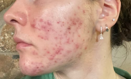 Customer photo review of Starter Acne Program™