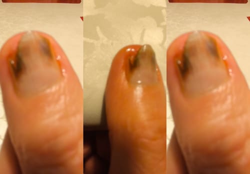 Customer photo review of Onychom - Lézeres Körömgomba Eltávolító Készülék