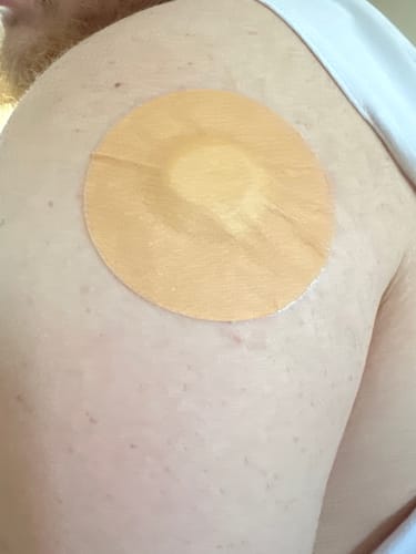 Customer photo review of Skin Grip MAX Freestyle Libre 2 Patches - 10 Pack