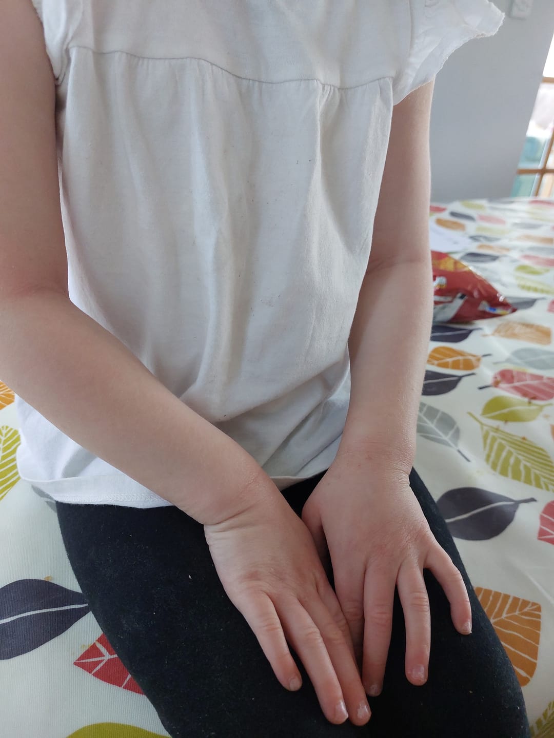 Customer photo review of Bioskin Junior Duo Pack (Free Outbreak Rescue Cream)