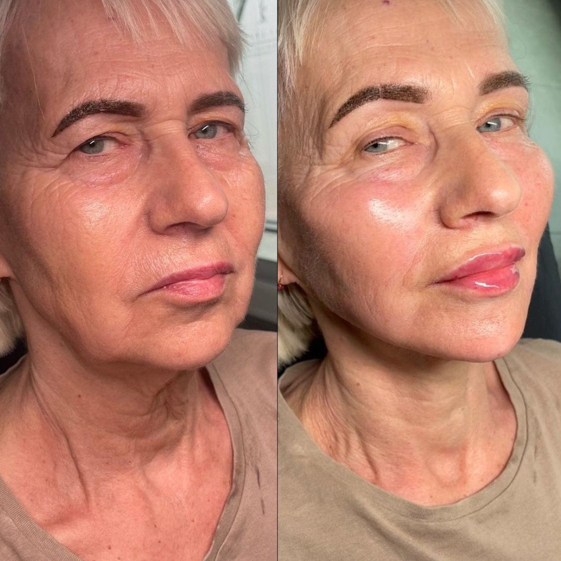 Customer photo review of Glov Serum-Infused Microneedle Eye Patches