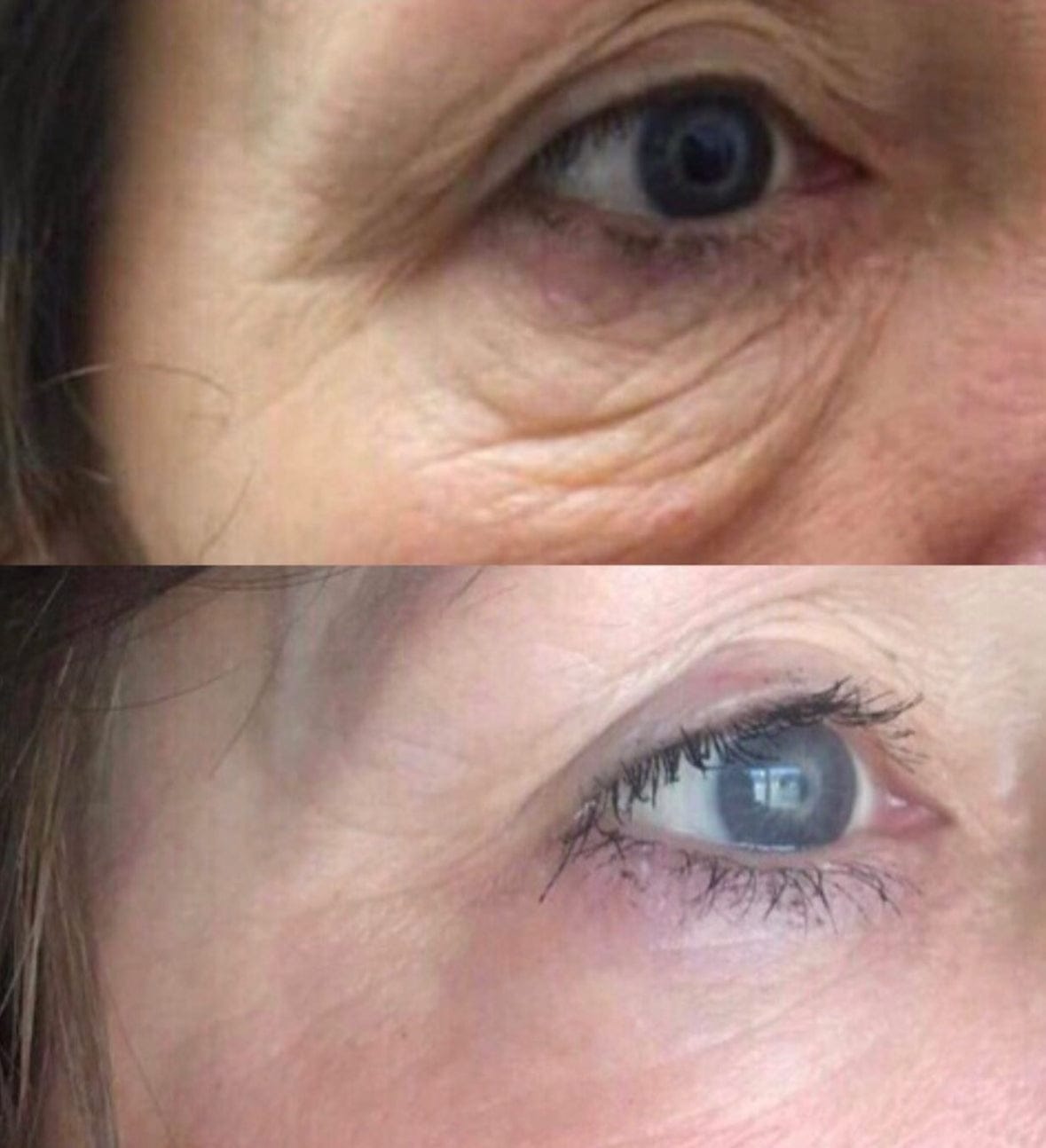 Customer photo review of Glov Serum-Infused Microneedle Eye Patches